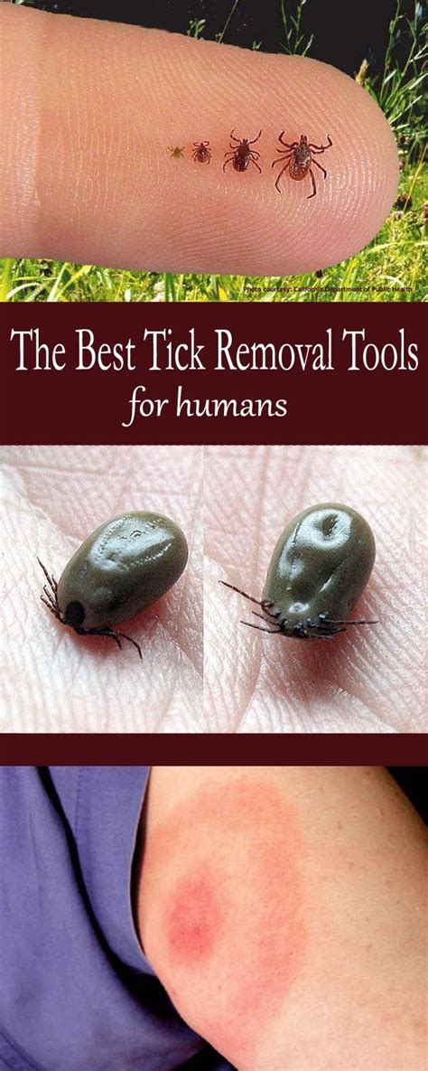 how to get ticks out.